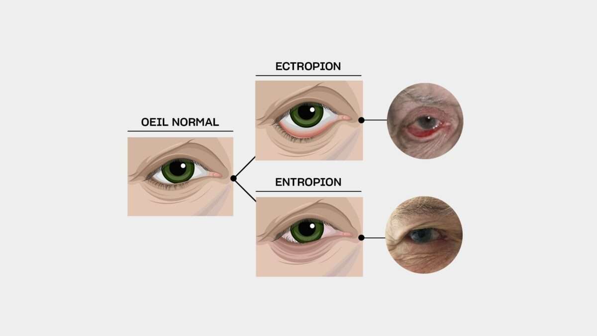 decollement paupiere inferieure ectropion