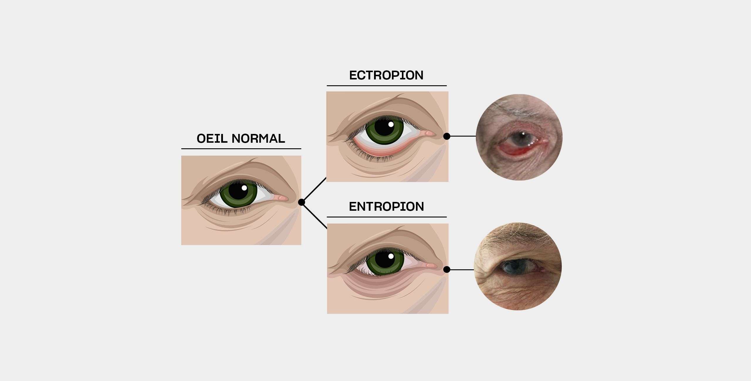 decollement paupiere inferieure ectropion