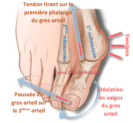 chirurgie orteils en griffe