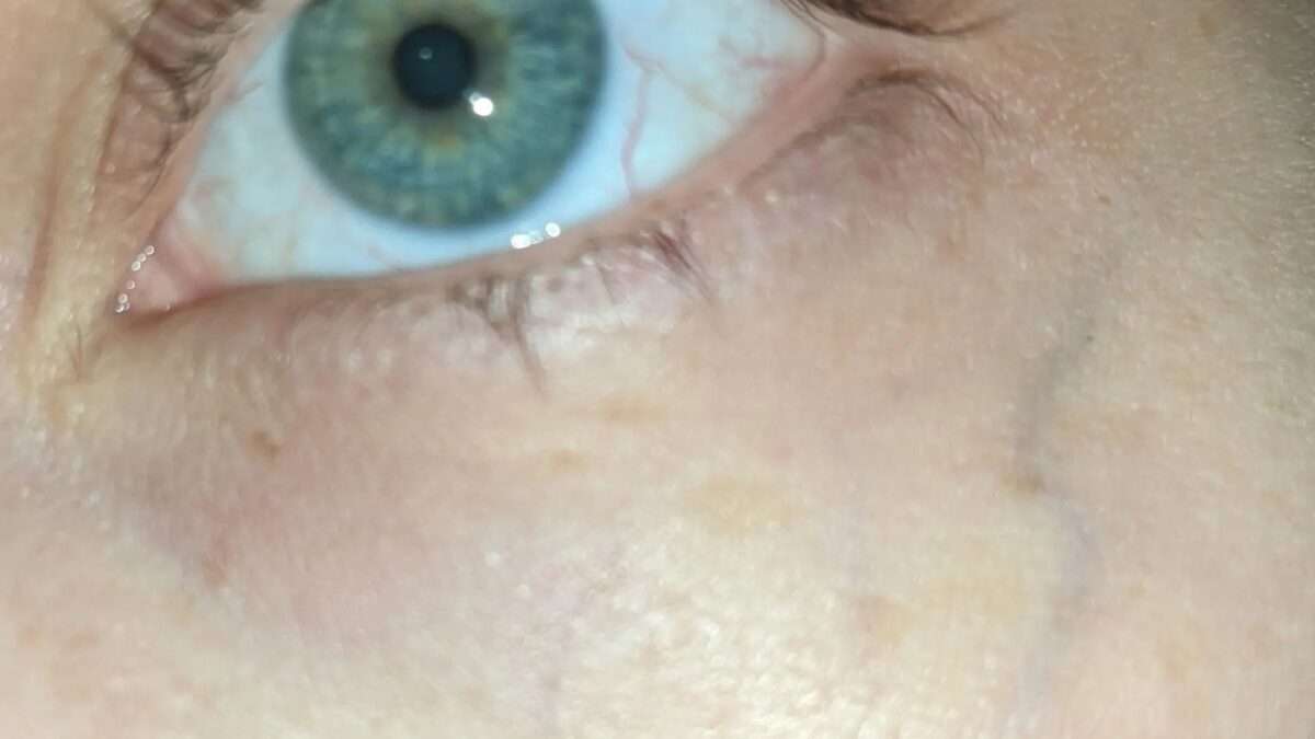 Traitement des veines sous les yeux : Comment s'en débarrasser ?