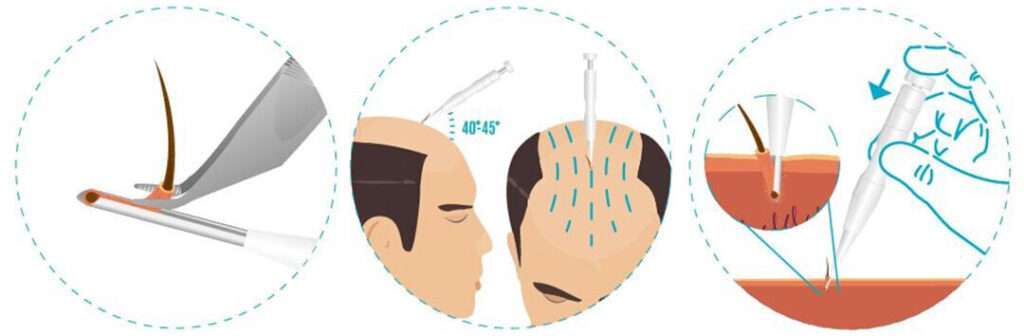 زراعة الشعر في تونس