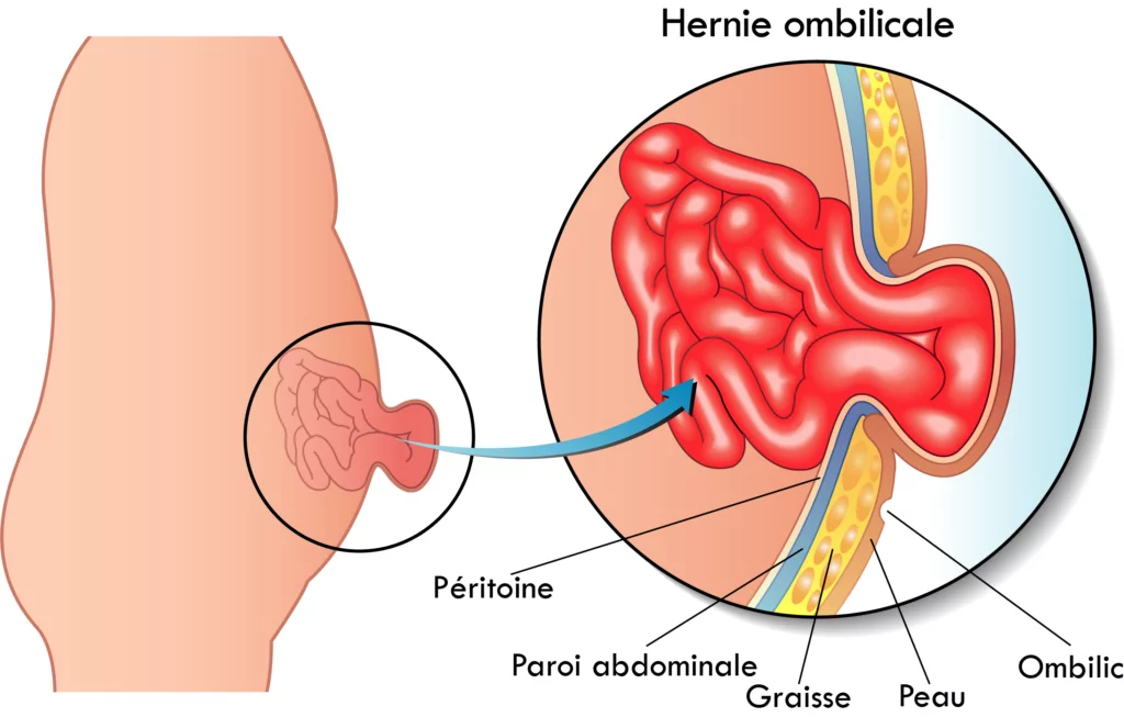 chirurgie hernie ombilicale