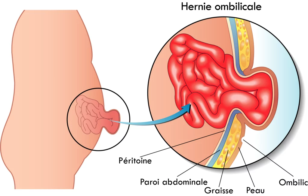 Quelle est la différence entre une hernie ombilicale et un diastasis ?