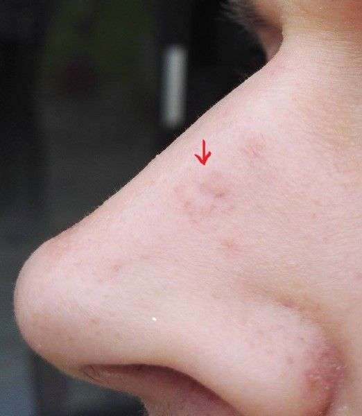 rhinoplastie apres carcinome épidermoïde