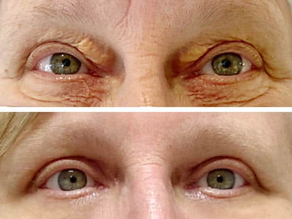 Traitement du Xanthelasma au laser