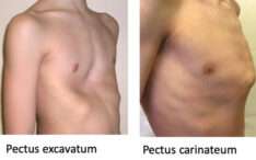 Pectus Types Pectus excavatum, carinatum et arcuatum : points de différence