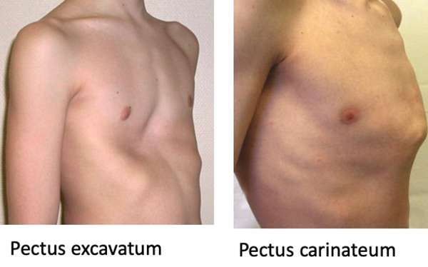 pectus excavatum vs pectus carinateum