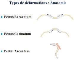 types déformations thorax