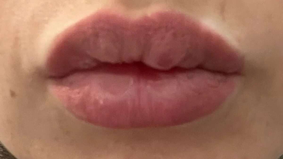 boule apres lip fillers