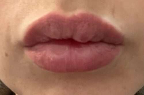 boule apres lip fillers