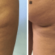 Subcision et lipofilling contre cellulite