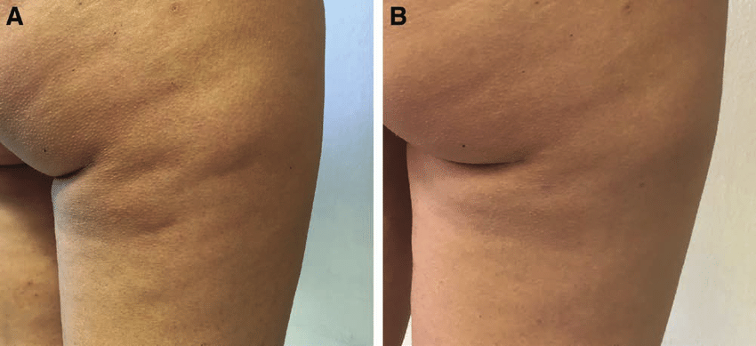 Subcision et lipofilling contre cellulite