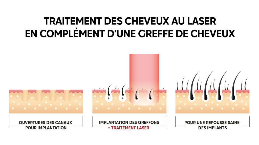 greffe cheveux laser