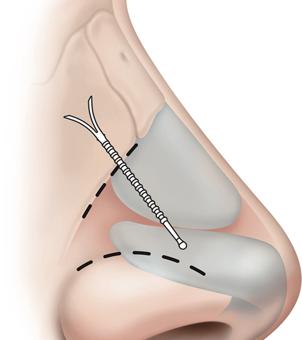 retrait implant nasal en silicone