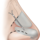 retrait implant nasal en silicone