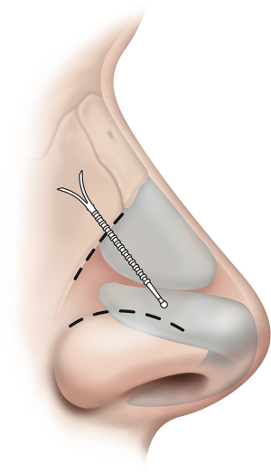 retrait implant nasal en silicone