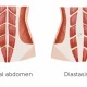 points de suture sur un diastasis