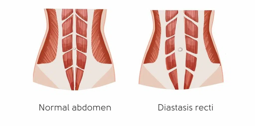 points de suture sur un diastasis