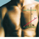 retrait implant pectoraux raté