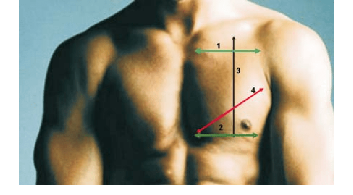 retrait implant pectoraux raté