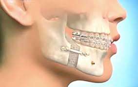 Chirurgie esthétique de la mâchoire