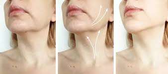 Chirurgie esthetique du menton avant apres