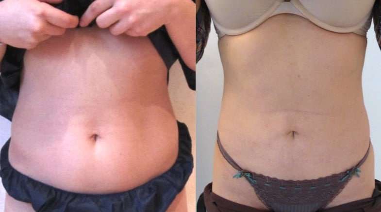 chirurgie esthetique liposuccion hanches avant apres