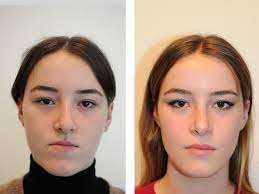 chirurgie esthetique machoire avant apres
