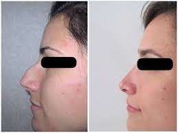 chirurgie esthetique nasale avant apres