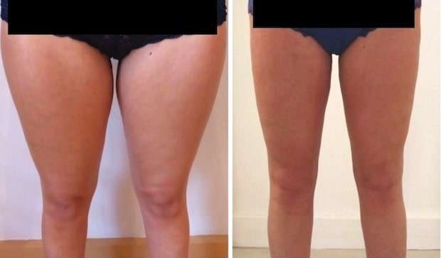 liposuccion cuisses avant apres