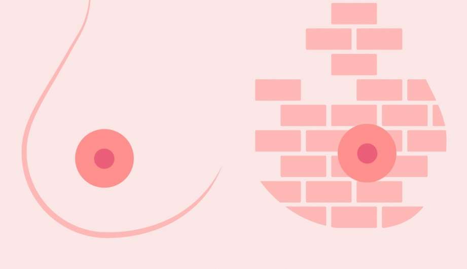 reconstruction seins