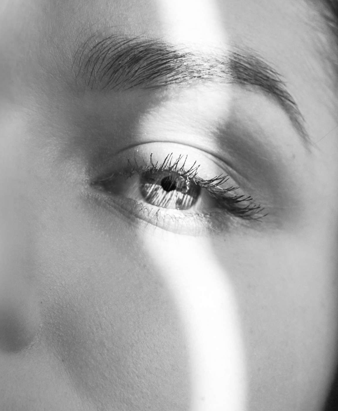 Blépharoplastie des paupières inférieures + lipofilling du trait de cerne