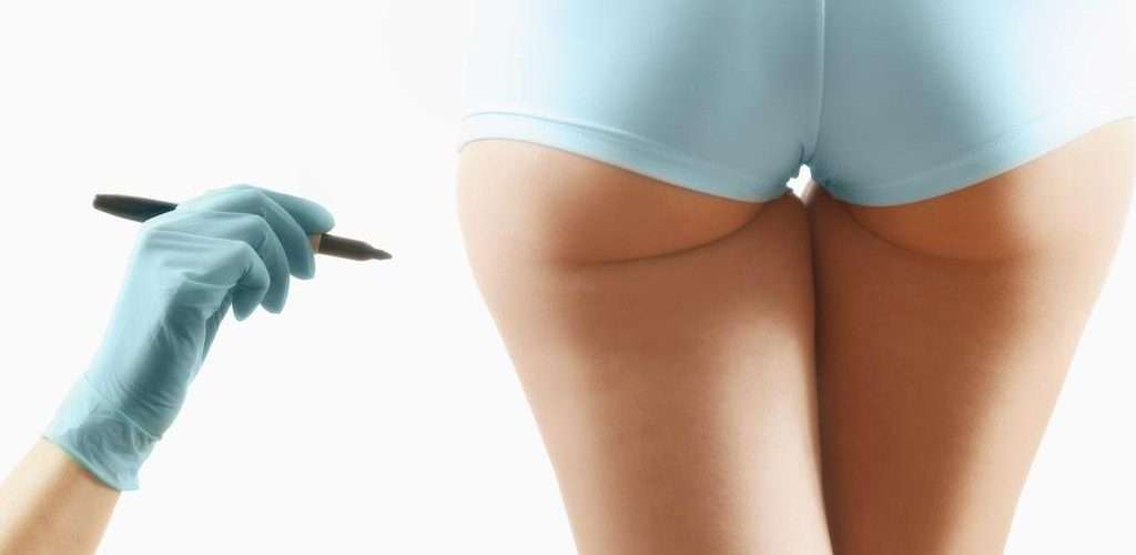 Chirurgie d'élargissement des fessiers et les hanches