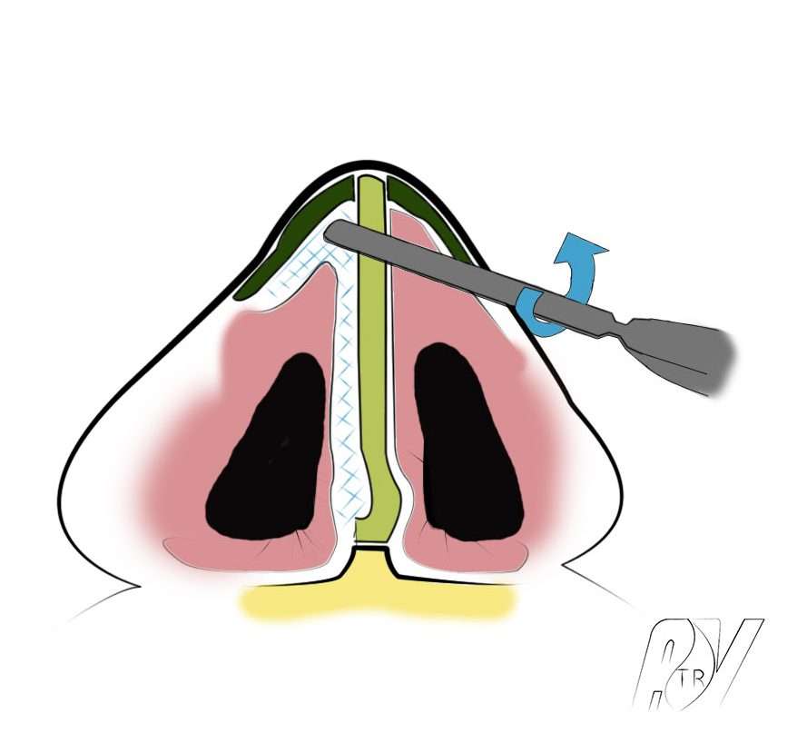 allongement nez avec cartilage