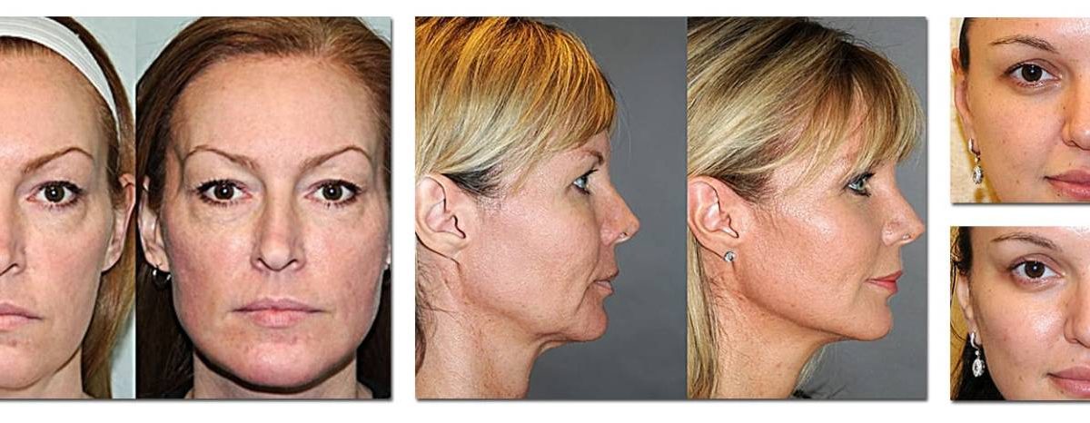 liteLift™ surgery