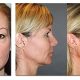 liteLift™ surgery