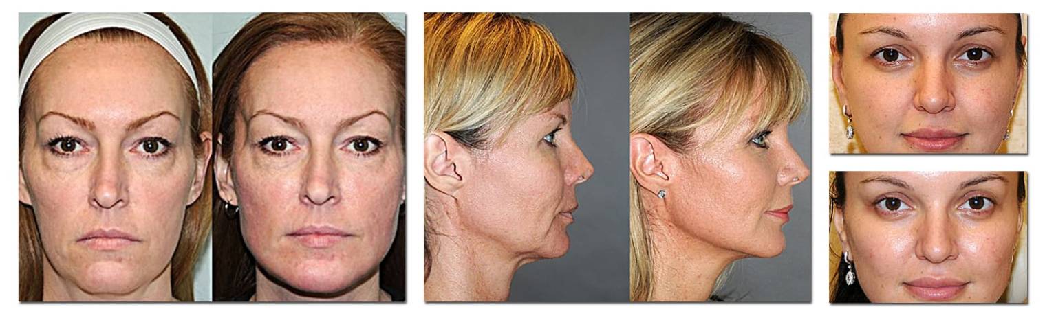 liteLift™ surgery