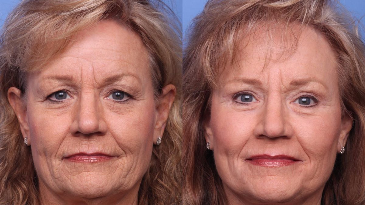litelift surgery vs deep plane facelift
