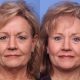litelift surgery vs deep plane facelift