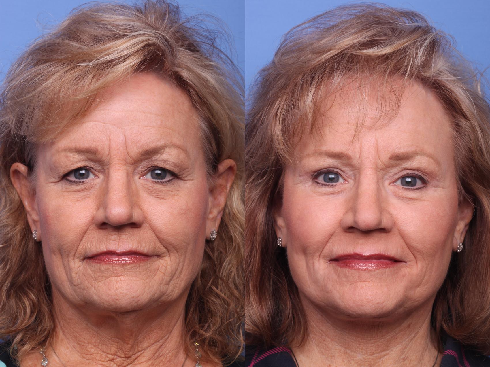 litelift surgery vs deep plane facelift