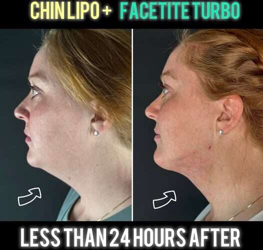 FaceTite Turbo + Morpheus Burst Jawline