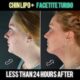FaceTite Turbo + Morpheus Burst Jawline