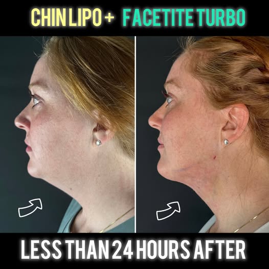 FaceTite Turbo + Morpheus Burst Jawline