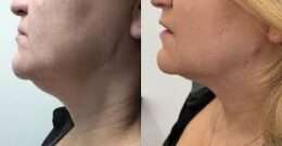 FaceTite Turbo + Morpheus Burst Lower Face + Neck
