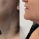 FaceTite Turbo + Morpheus Burst Lower Face + Neck