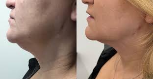 FaceTite Turbo + Morpheus Burst Lower Face + Neck