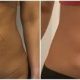 jplasma apres liposuccion