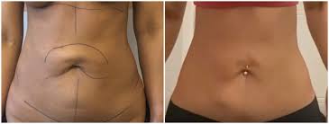 jplasma apres liposuccion