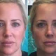 radiesse jawline contouring