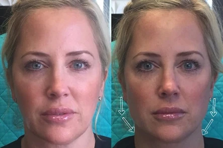 radiesse jawline contouring